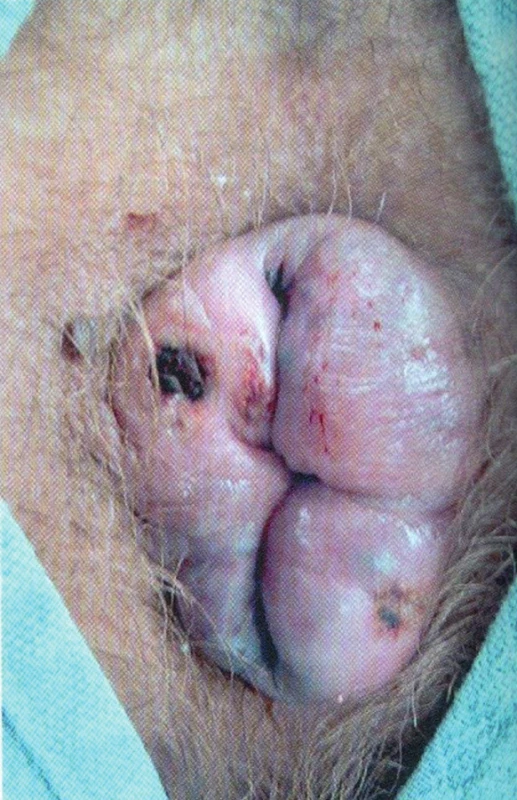 Prolabující vnitřní trombotizované hemoroidy
Fig. 2: Prolapse of internal thrombosed haemorrhoids