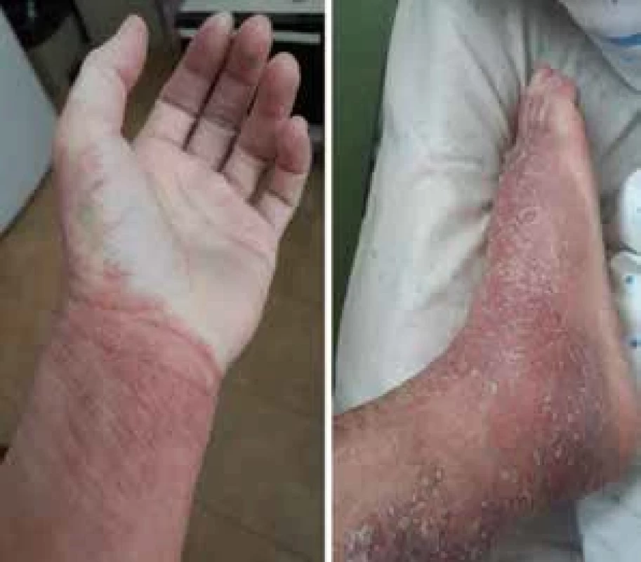 Erytrodermie, red sleeves