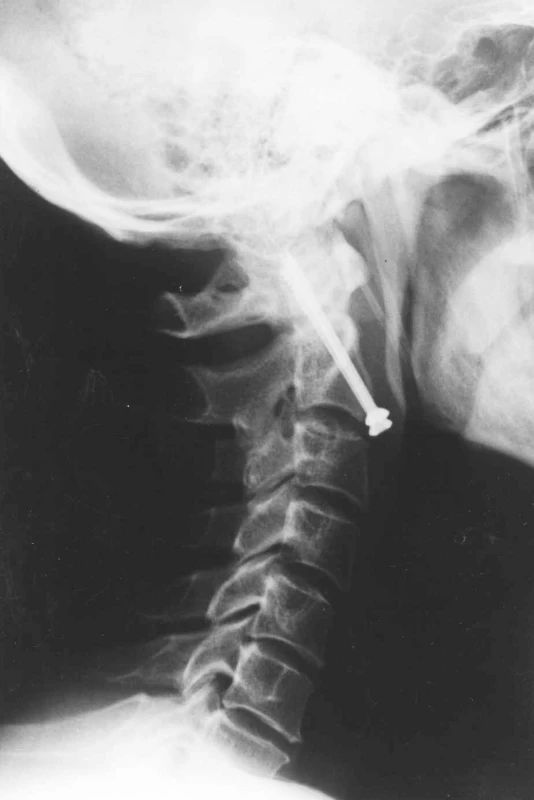 RTG obraz kompresní osteosyntézy kanalizovanými šrouby v axiální ose
Fig. 3. X-ray axial view of the compression osteosynthesis with canalised screws