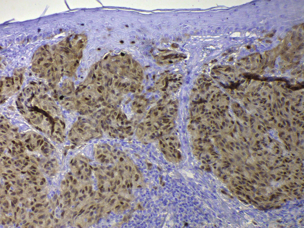 Pozitivita SOX10, jaderná pozitivita s nespecifickým signálem v cytoplazmě, v buňkách melanomu
Breslow 1,7, zvětšeno 200x