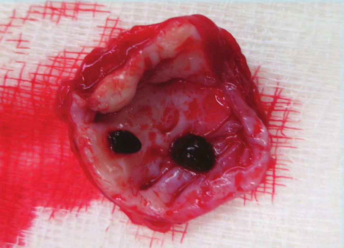 Trombotické hmoty ve vaku aneuryzmatu
Fig. 6: Thrombotic masses in the aneurysmal sac