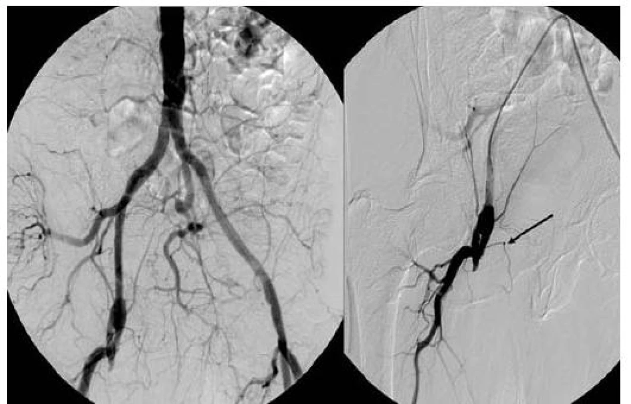 Angiografie pánevních a femorálních tepen při přijetí – uzávěr femoropopliteálního bypassu v odstupu vpravo (šipka).
