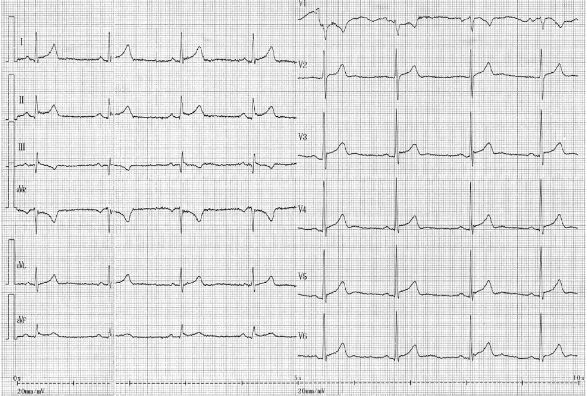 Popis EKG: sinusové vlny P, frekvence komor 52/minutu. P-Q 0,20 s. Komplexy QRS široké 0,08 s, elektrická osa 45 stupňů, ve V1 komplex rS, přechodová zóna V3-4. Úseky S-T jsou v povrchových svodech elevovány až o 2 mm a ve většině svodů začínají uzlíkem v elevovaném junkčním bodě. Vlny T jsou vysoké, asymetrické.