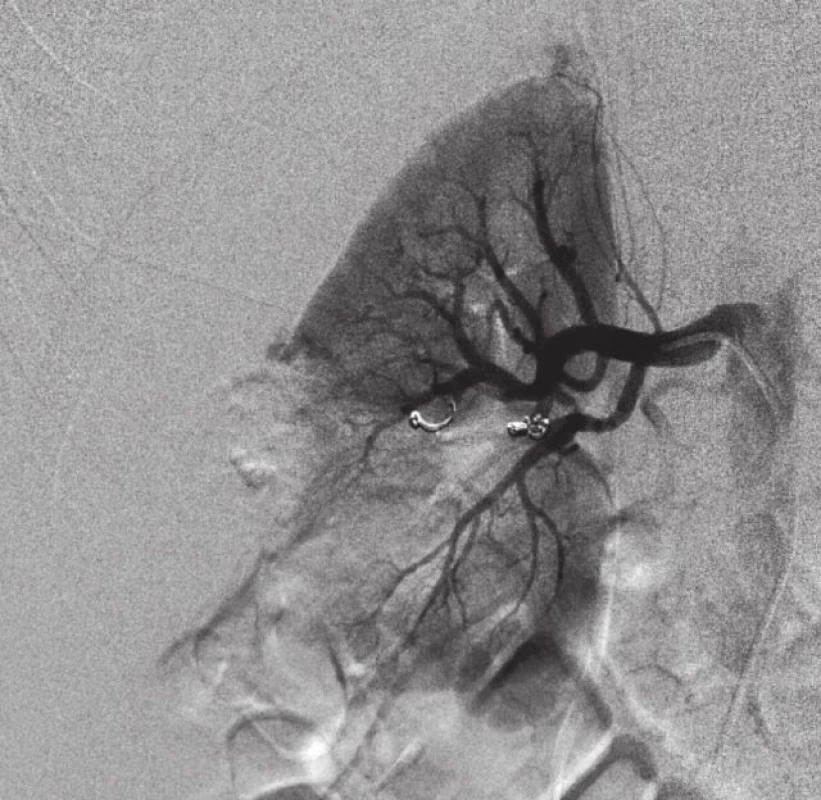 Superselektivní embolizace tří segmentárních tepen a vyřazení cévního zásobení AML Embolizováno PVA částicemi, absolutním alkoholem a spirálami.
Fig. 6. Superselective embolization of three segmental arteries and elimination of the vascular supply of an angiomyolipoma Embolized with the use of PVA particles, absolute alcohol and coils. 