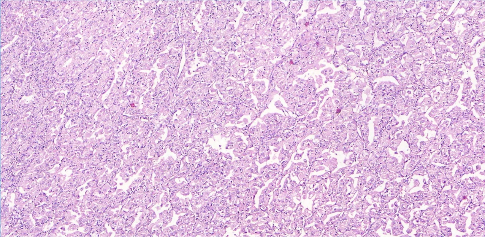 U pacientky s lokálně pokročilým TFE3 rearanžovaným RCC byl histologicky zastižen papilárně/tubulopapilárně uspořádaný tumor. Papily jsou lemovány buňkami s objemnou, jemně granulární cytoplazmou, jádra jsou nepravidelná s prominentními jadérky (nuclear grade 3 WHO/ISUP) (HE, zvětšeno 50×). Fig. 2. In a patient with locally advanced TFE3-rearranged RCC, histologic examination revealed a papillary to tubulopapillary tumor architecture. The papillae are lined by cells with abundant, finely granular cytoplasm, the nuclei are irregular with prominent nucleoli (WHO/ISUP nuclear grade 3) (H&E ×50). 