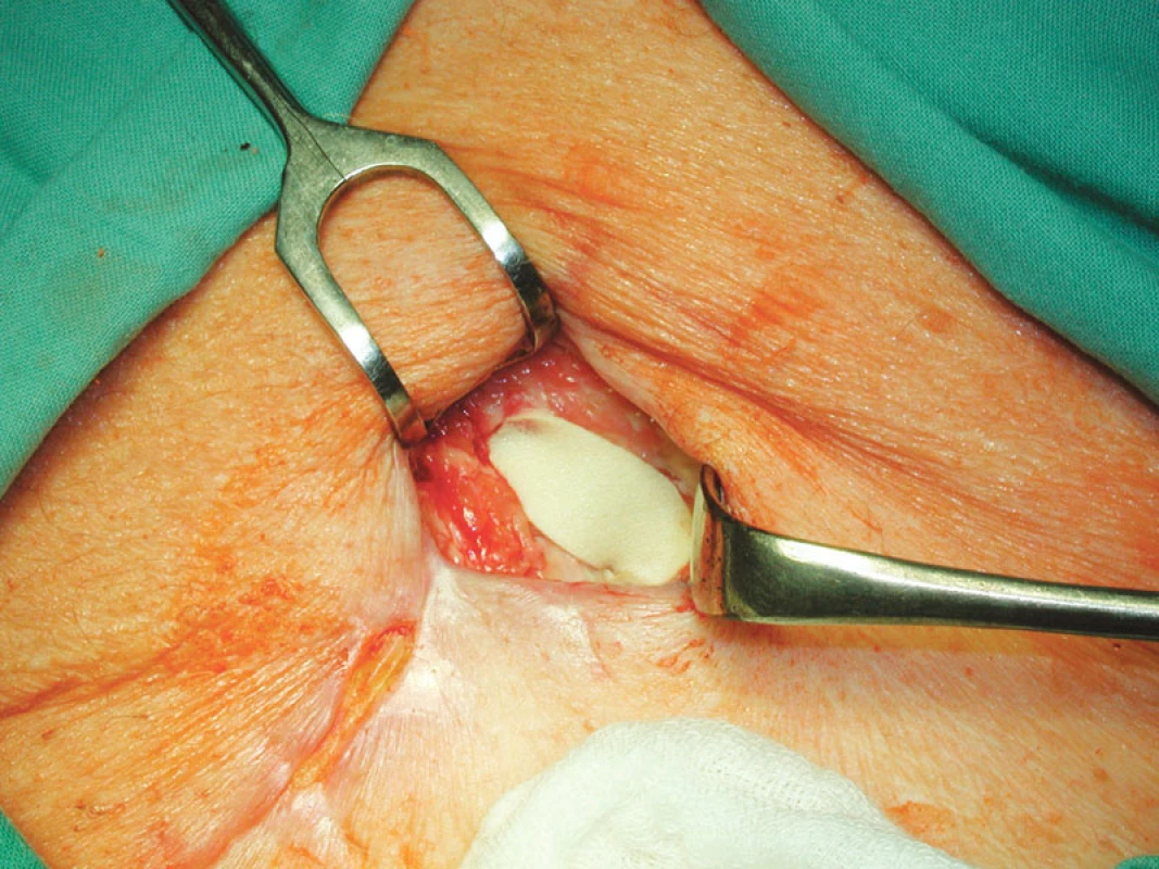Překrytí obnažené cévní protézy vnitřní vrstvou z krytí Tielle
Fig. 4. An exposed PTFE prosthesis covered using an inner layer of the Tielle wound dressing