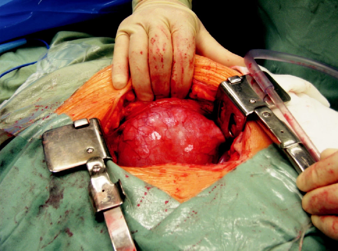 Objemná lymfokéla, která vyklenuje do operační rány
Fig. 4. A large lymphocele, buldging into the surgical wound