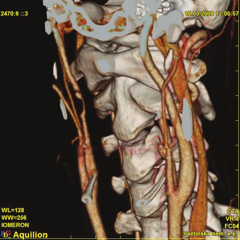 Patrné poškození a trombóza ACI vpravo 
Fig. 3. Trauma and thrombosis of the ACI is detectable on the right