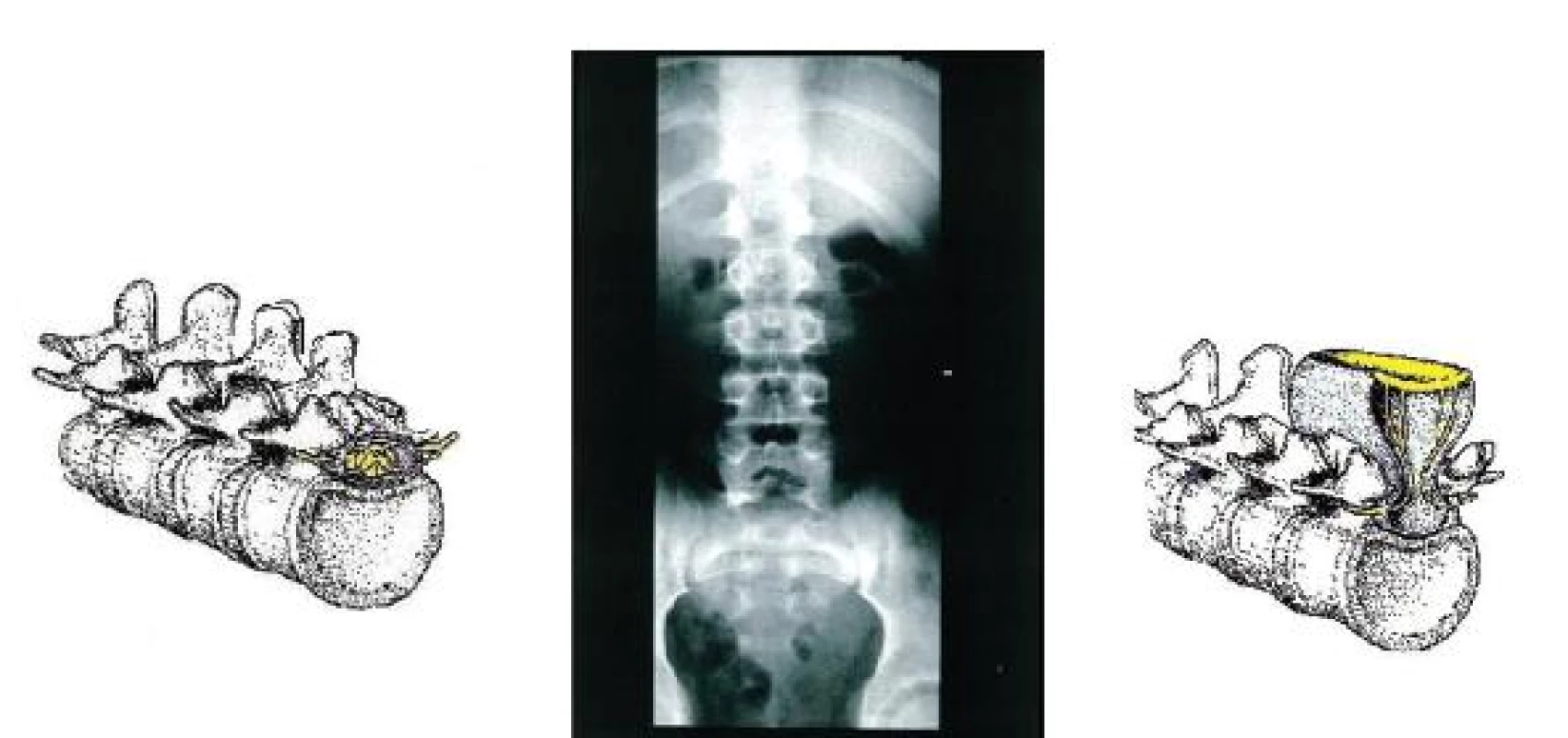 Spina bifida L5. Vo väčšine prípadov iba náhodný nález. Ak má pacient kliniku (poruchy vyprázdňovania stolice a moču, poruchy hybnosti a citlivosti dolných končatín) je potrebné aktívne pátrať po niektorom type zo zatvorených NTD
Fig. 3. Spina bifida at L5 level. In most cases, only an accidental finding. In patients presenting with clinical symptomatology (stool and bladder dysfunction, lower extremities mobility and sensation disorder), active search for a type of closed NTD is recommended