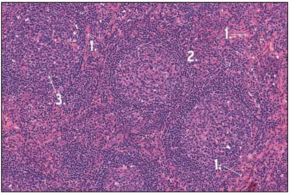 Histologický obraz Castlemanovy nemoci. 1 – zesílená stěna cév hyalinem, 2 – zachovalá architektonika LU, 3 – atretický folikul.