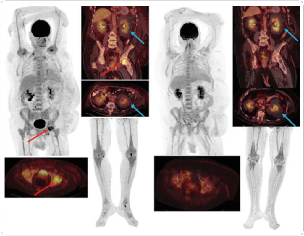 Vlevo FDG-PET/CT ze 17. 12. 2024, vpravo FDG-PET/CT z 10. 4. 2026. Červenými šipkami označena aktivní hlavice l. femuru kde byla při prvním vyšetření vyšší aktivita, modrými šipkami jsou označeny neaktivní kolekce tekutiny kolem ledvin. Kolem levé ledviny se perirenální kolekce tekutiny zvětšila oproti přechozímu prvního FDG-PET/CT zobrazení, a proto konzultujeme s urology možné řešení.