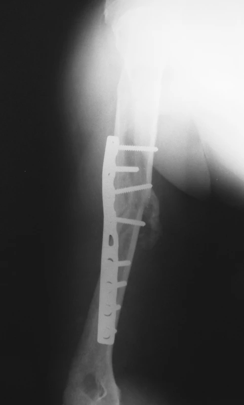 Pooperační RTG snímek ošetření pakloubu dynamickou kompresní dlahou
Fig. 2. Postoperative X-ray picture of nonunion treated by dynamic compression plate