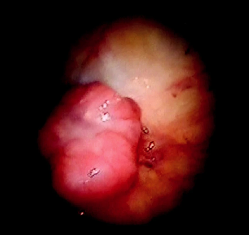 Ložisko adenokarcinómu v bielom svetle
Fig. 3. A focus of adenocarcinoma in white light