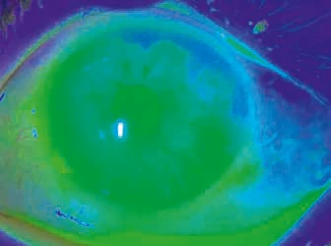 Těžké poleptání rohovky a spojivky vápnem – rozsah poranění je znázorněn po obarvení tkáně fluoresceinem v modrém kobaltovém světle na štěrbinové lampě. Severe chemical burn of the cornea and conjunctiva caused by lime – the extent of the injury is visualized after fluorescein staining under cobalt blue light on slit-lamp examination.