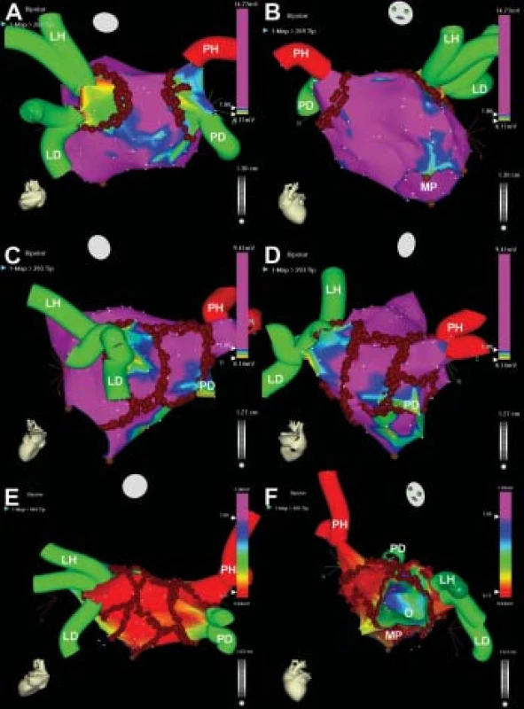 Elektroanatomické mapování a obkružující a lineární léze v levé srdeční síni. Na obr. 2 jsou příklady elektroanatomického mapování (voltážové mapy) a různých ablačních strategií u 3 pacientů. Na částech A a B jsou pohledy na zadní stěnu resp. a přední stěnu levé srdeční síně a na plicní žíly. Na voltážové mapě levé síně, v níž je amplituda EKG signálů v jednotlivých místech vyobrazena v barevném spektru (viz barevná škála na sloupci vpravo), jsou odděleny hodnoty větší a menší než 1 mV. Hnědé body znázorňují jednotlivá místa aplikací radiofrekvenční energie ve formě jednoduchých obkružujících lézí kolem levých a pravých plicních žil. Tato strategie je dostačující u pacientů s incesantními fibrilacemi síní kratšího trvání, u nichž je zjevnou příčnou fibrilace síní 1 nebo více jasně arytmogenních plicních žil. Na obr. 2C a 2D jsou pohledy na zadní stěnu levé síně a plicních žil u jiného pacienta, u nějž jsou obkružující léze kombinovány se 3 lineárními lézemi v levé srdeční síni. Na obrázku 2C je vidět lineární lézi spojující levou obkružující lézi od levé dolní plicní žíly k posterolaterálnímu aspektu mitrálního prstence, jejímž smyslem je preventivní eliminace reentry okruhu kolem mitrálního prstence. Obě obkružující léze jsou dále spojeny 2 lineárními lézemi nahoře ve stropě levé síně a dole mezi dolními plicními žilami. Jejich smyslem je eliminace potenciálních ektopických ložisek lokalizovaných mimo vlastní plicní žíly a „mateřských“ reentry okruhů na zadní stěně levé síně a také preventivní přerušení potenciálních reentry okruhů kolem obkružujících lézí. Tuto strategii využíváme u pacientů s intermitentní fibrilací síní, kdy jednotlivé epizody trvají hodiny až několik dní, a u nichž je tedy spoluúčast síňového myokardu v mechanizmu fibrilace síní suspektní. Na obr. 2E a 2F jsou pohledy na levou síň a plicní žíly u jiného pacienta zezadu (2E) a zepředu (2F). Kromě obkružujících lézí jsou zde přítomny komplexní lineární léze. Ty navíc oproti obrázku 2D a 2C spojují oblast pravé dolní plicní žíly s posteriorním aspektem mitrálního prstence, dále horní lineární lézi s anteriorním aspektem mitrálního prstence kolem ouška levé síně vpředu a konečně spojují napříč přepážkou pravou horní plicní žílu s foramen ovale. Tato strategie je používána jednak u pacientů s chronickou fibrilací síní, a také u pacientů s intermitentní fibrilací síní, u nichž se v mechanizmu fibrilace síní uplatňuje arytmogenní substrát pramenící z vlastní síně a spočívající v disperzní vazivové přeměně levé srdeční síně (což se odráží v nízkých amplitudách EKG signálu ve voltážové mapě).