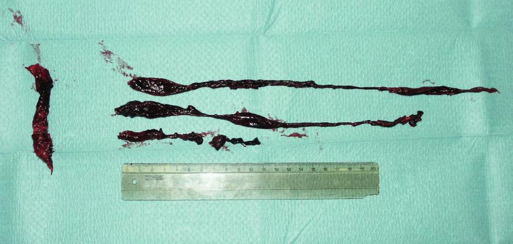 Chirurgicky odstraněný žilní embolus
Fig. 1. Surgically removed venous embolus