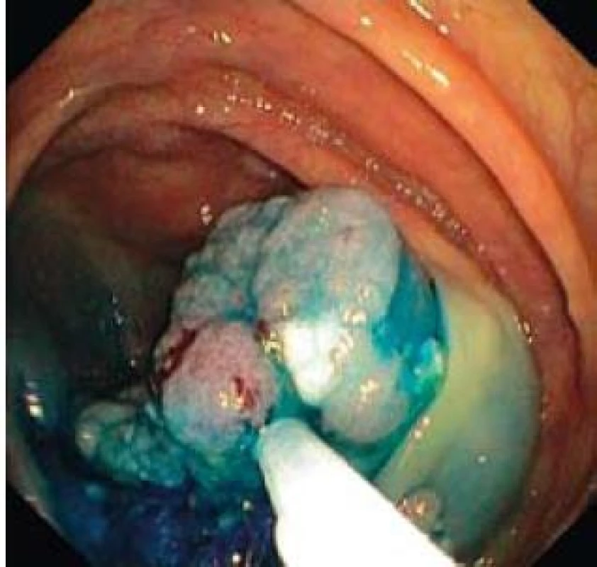 Endoskopická resekce kličkou po částech.
Fig. 4. Endoscopic piecemeal resection, lift-and-cut by snare.