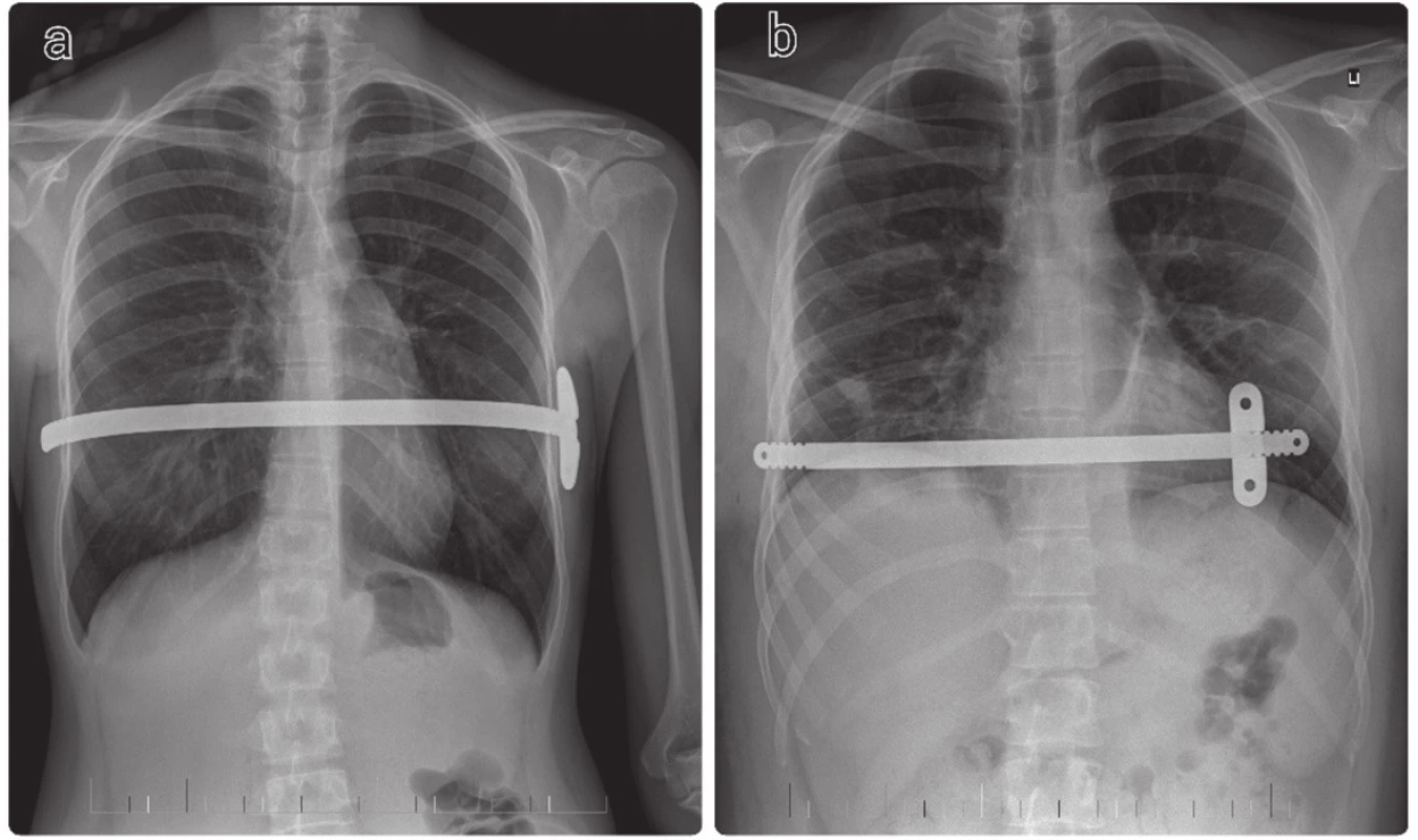 RTG nález u pacientov po MIRPE
a) Pacient po štandardnej MIRPE
b) Pacient po „short-bar“ technike
Fig. 6: Chest X-ray in MIRPE patients
a) CXR after standard MIRPE procedure
b) CXR after „short-bar“ technique