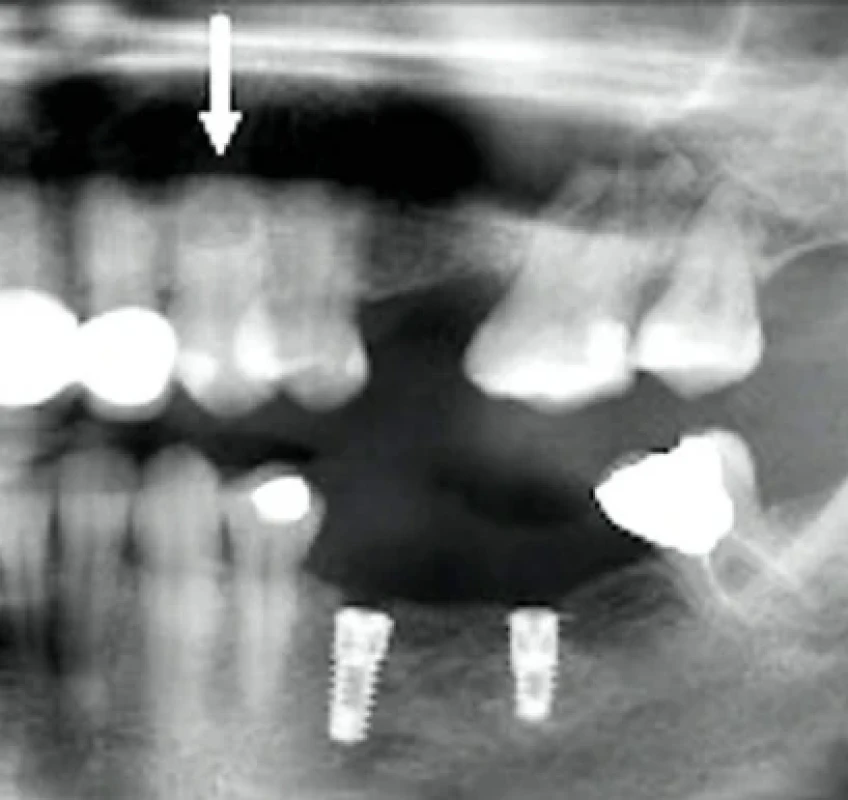 Interná resorpcia zuba 23 viditeľná na OPG snímke. Zdroj: Simona Fritzká. Fig. 6 Internal root resorption of tooth 23 visualised on OPG X-ray. Source: Simona Fritzká.
