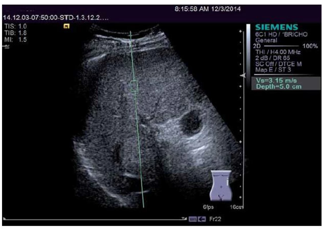 Elastografie jater pomocí ARFI (přístroj Siemens Acuson S2000). Obdélník představuje oblast měření. Pro měření v játrech je nejvhodnější vzdálenost 3 cm pod jaterním pouzdrem. Měření prováděná povrchověji jsou zkreslena přítomností vaziva v jaterním pouzdře a vykazují falešně vyšší hodnoty.
Fig. 2. Elastography of the liver using ARFI (Siemens Acuson S2000 device). The rectangle represents the area of measurement. For measurement in the liver the most appropriate distance is 3 cm below the liver capsule. Measurements made closer to the surface are distorted by the presence of connective tissue in the liver capsule and show falsely higher values.