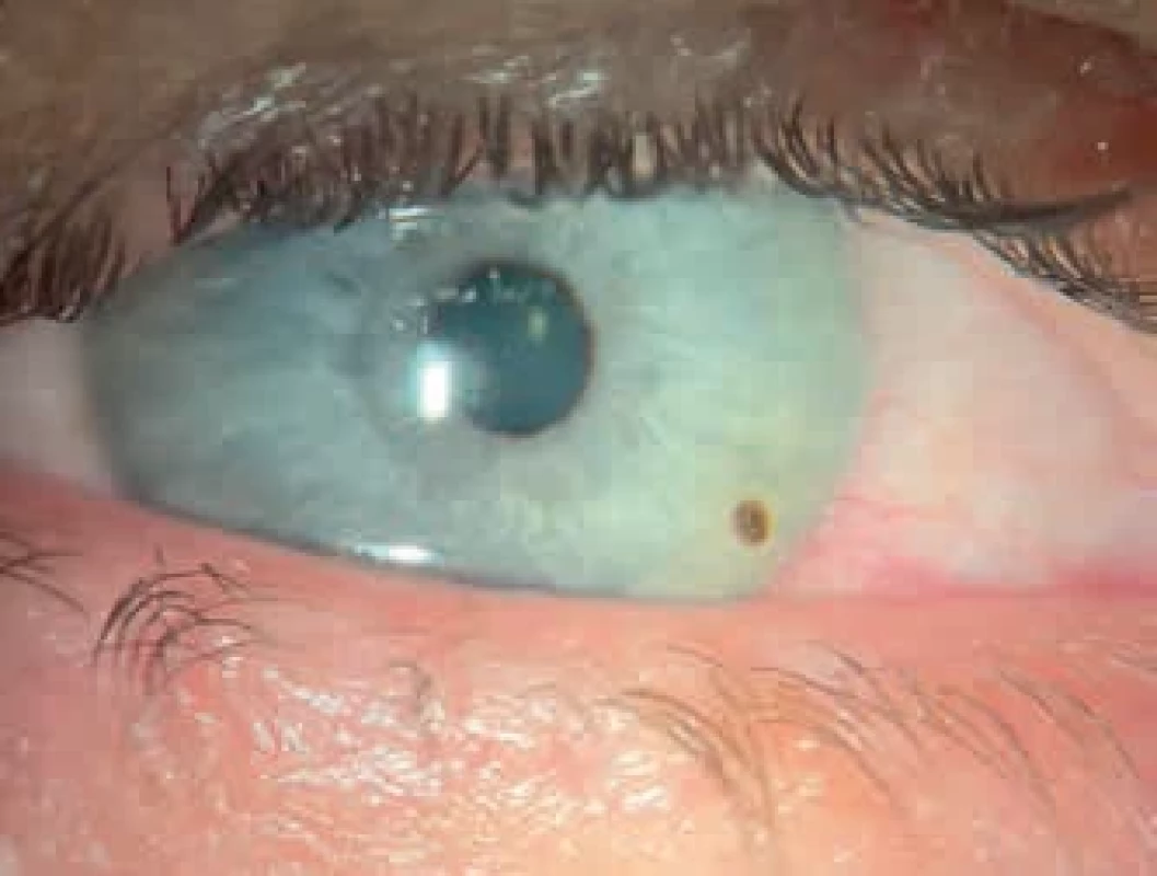 Kovové cizí tělísko v rohovce. Metallic corneal foreign body.