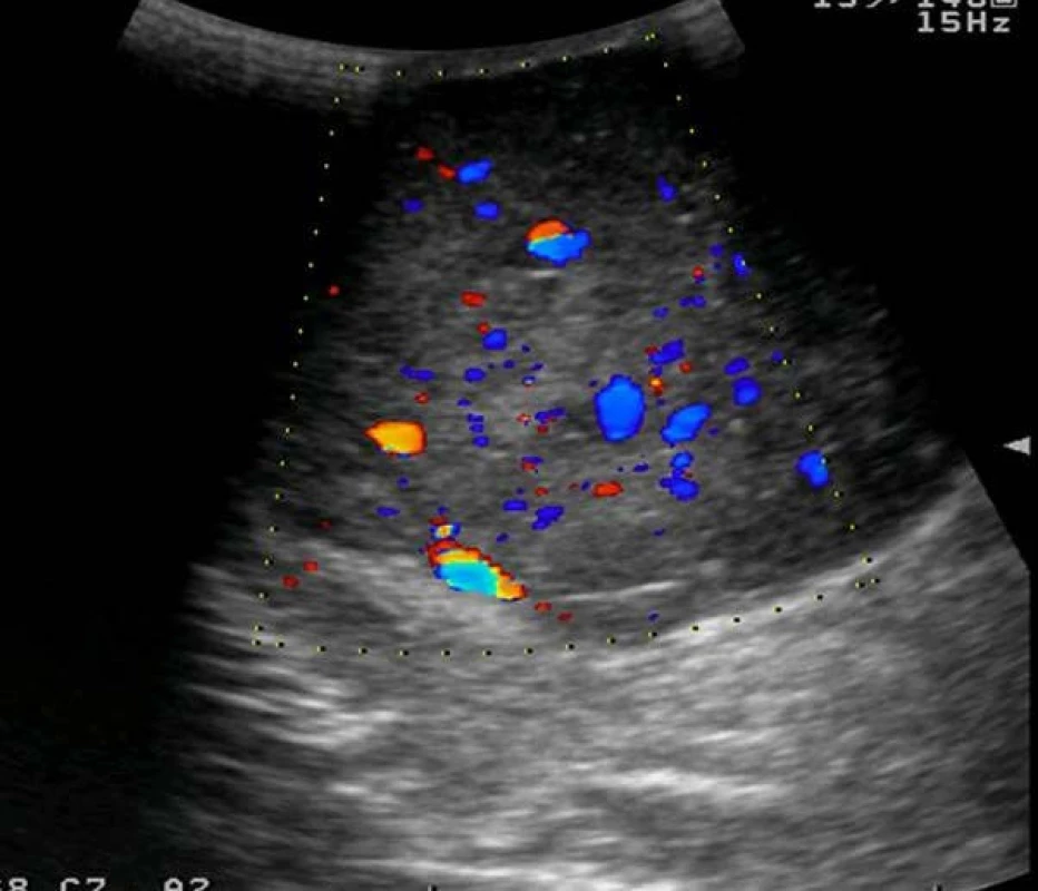 USG vyšetření varlete s patrnou hypervaskularizací tumoru
Fig. 2. Sonography of testis, hypervascularisation of tumour mass