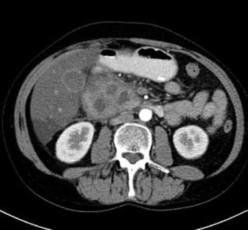 Autoimunní pankreatitida – CT nález.
Fig. 3. Autoimmune pancreatitis – CT finding.