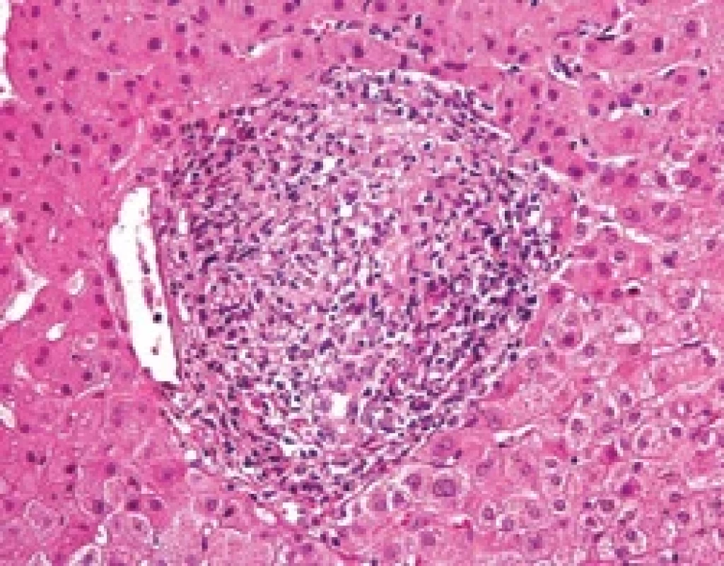 Histologický obraz PBC. Fig. 1. Histological picture of PBC.