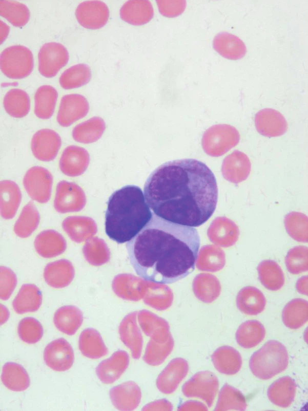 Blast, atypický promyelocyt a monocyt.