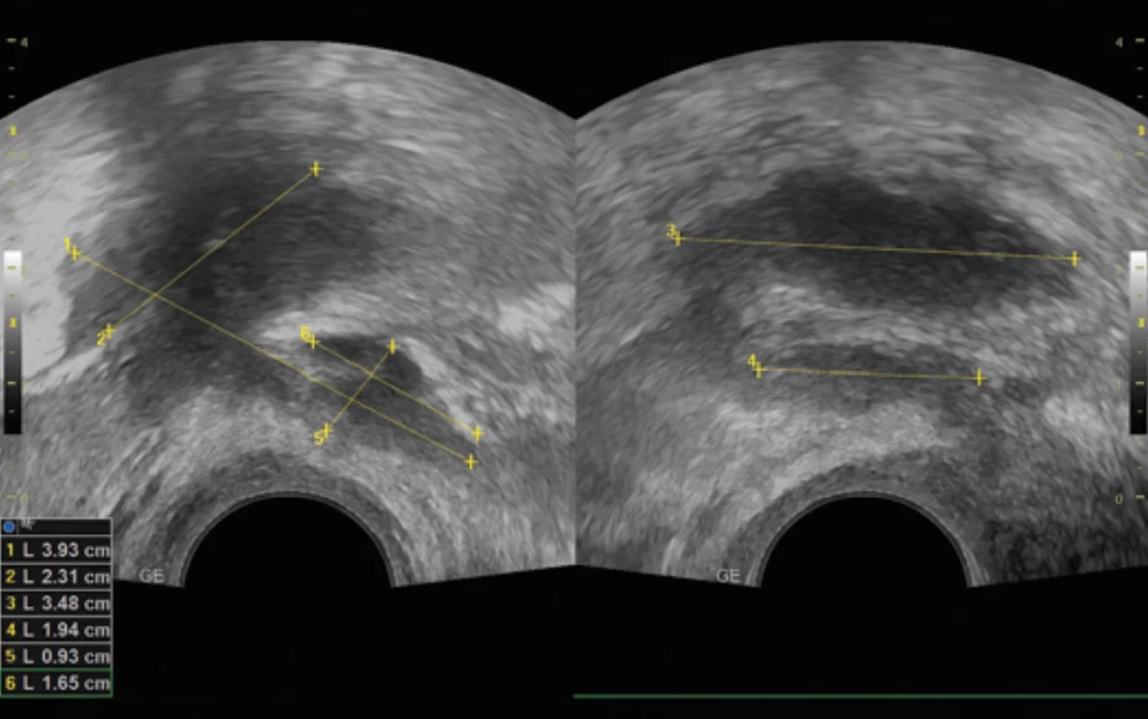  Ultrasound depiction of the nodules in rectum, rectovaginal septum and vaginal apex. Obr. 1. Ultrazvukové zobrazení uzlů v oblasti rekta, rektovaginálního septa a poševního apexu.