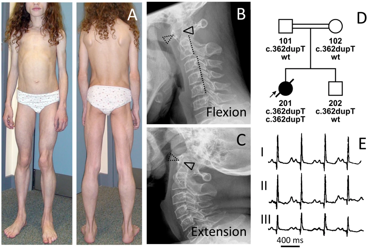 Phenotype of patient FII:201 from the UK.