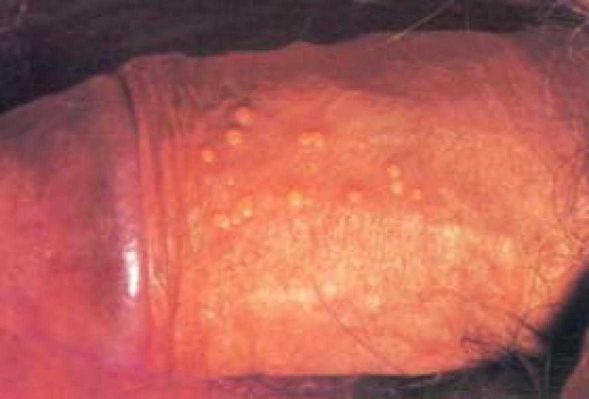 Genitální herpes.