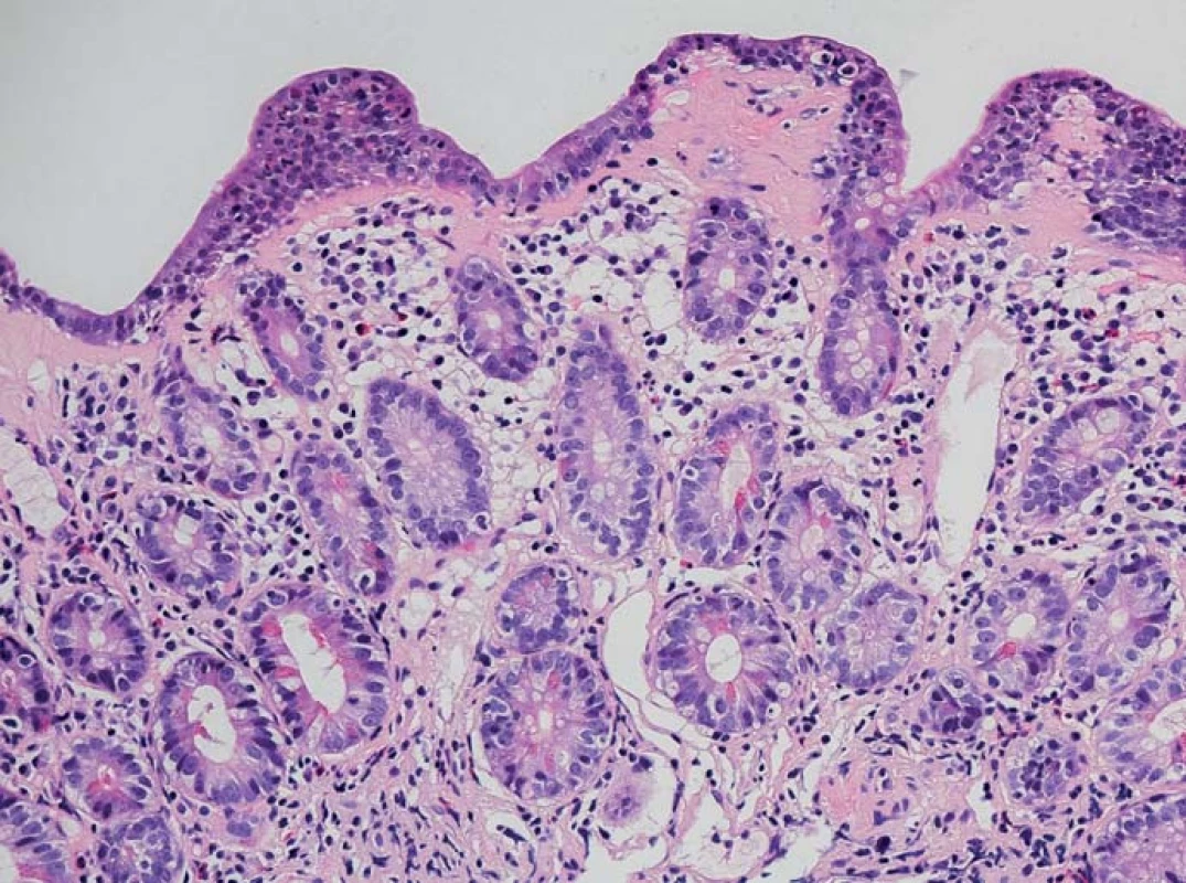 Histologický obraz sliznice terminálního ilea prokazující atrofii klků, intraepiteliální lymfocytózu, zánětlivou infiltraci lamina propria a pásovitý subepiteliální hyalinní materiál (hematoxylin-eozin, zvětšení 200×).
Fig. 3. Histology of terminal ileal mucosa con rming villi atrophy, intraepithelial lymphocytosis, in ammatory infiltration of lamina propria and band-like subepithelial hyalin material (haematoxylin-eosin, magnification 200×).