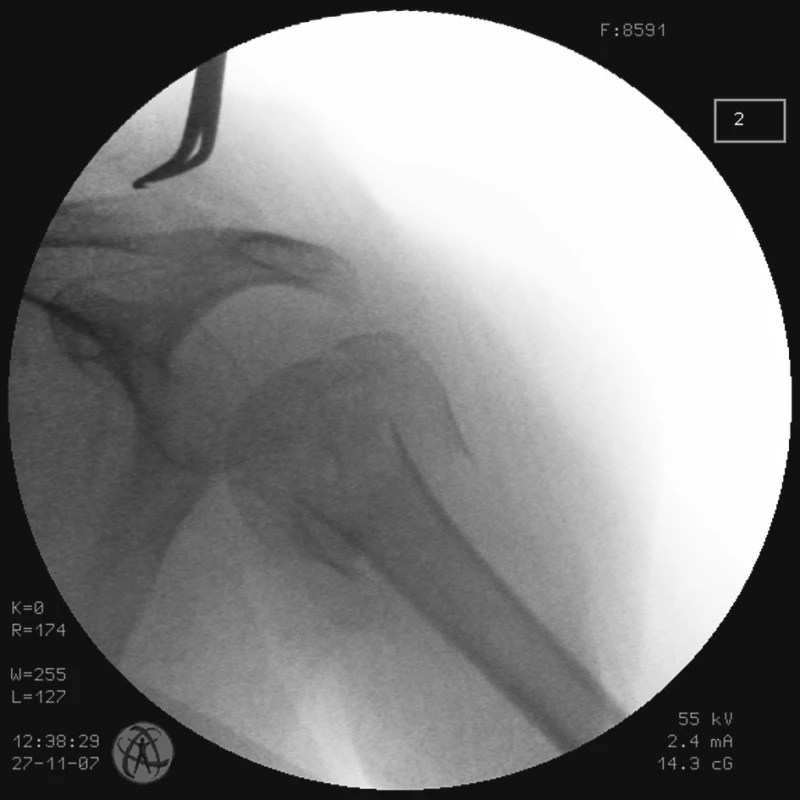 RTG obraz dislokované zlomeniny proximálního humeru u pacienta č. 1
Fig. 1. X- ray view of the dislocated proximal humeral fracture in a patient No. 1
