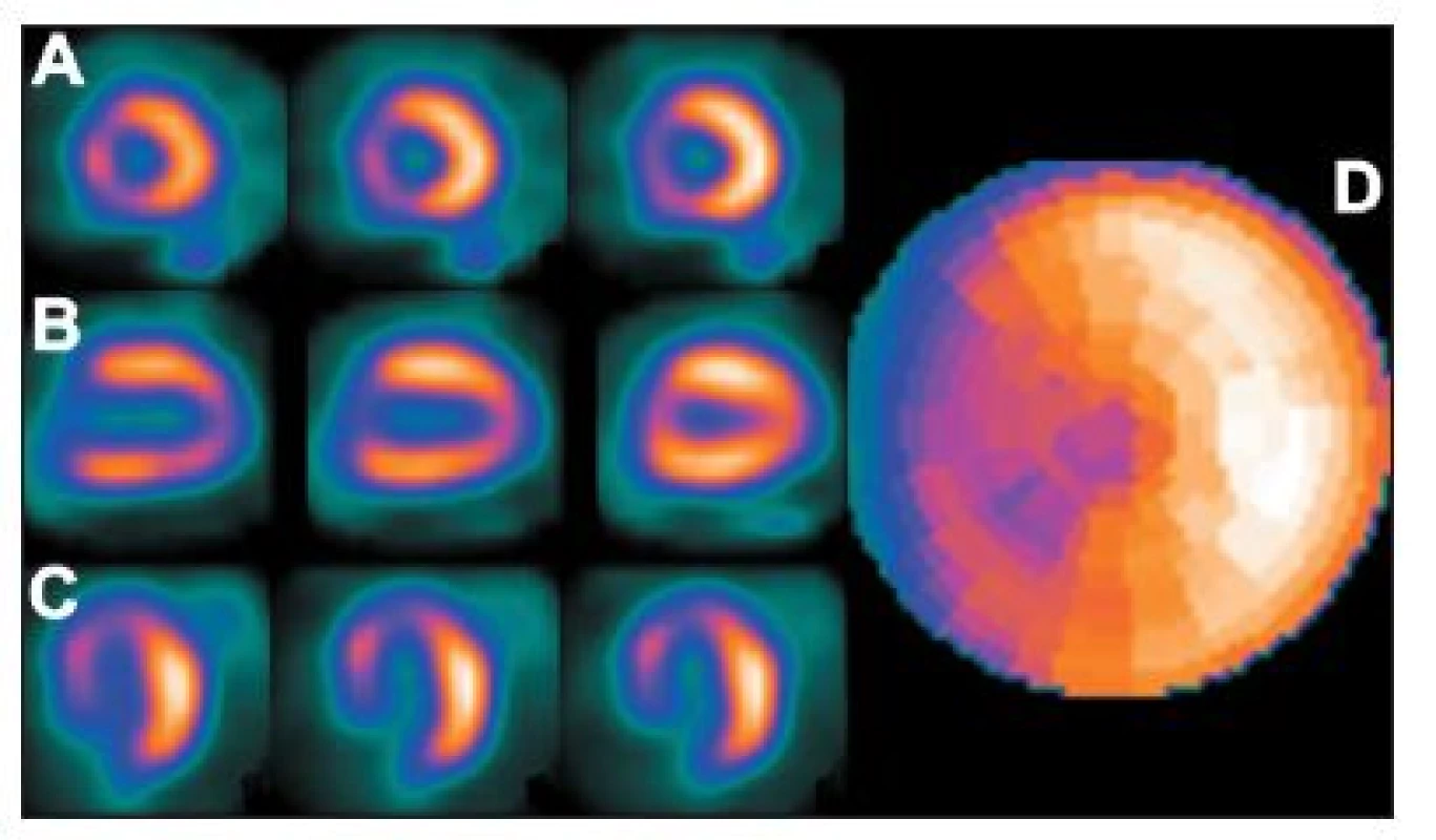 Studie pacienta s LBBB – zobrazuje se arteficiální defekt perfuze v oblasti septa na vybraných tomografických řezech (A – SA, B – VLA, C – HLA) a polární mapě (D).