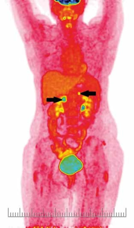 PET CT – černé šipky ukazují metastatický proces v oblasti obou nadledvin.
Fig. 5. PET CT scan – black arrows show metastases in both suprarenal glands.