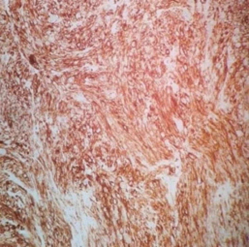 During immunohistochemical evaluation, tumor cells stained positive for smooth muscle marker caldesmon (20×).