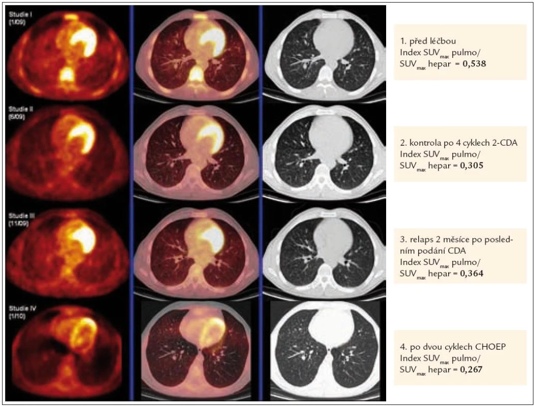 Korelace PET-CT plic a indexu SUV<sub>max</sub> pulmo/SUV<sub>max</sub> hepar před léčbou, kdy byl postižen plicní parenchym četnými nodularitami, typickými pro plicní formu LCH, po 4 cyklech léčby 2-chlorodeoxyadenosinem, kdy tyto nodularity vymizely, dále v době relapsu nemoci, kdy došlo k recidivě znovu i v plicním parenchymu (opět nové plicní nodularity) a po 2 cyklech léčby relapsu režimem CHOEP (cyklofosfamid, etoposid, adriamycin, vinkristin a prednison), kdy opětovně se aktivita nemoci minimalizovala.