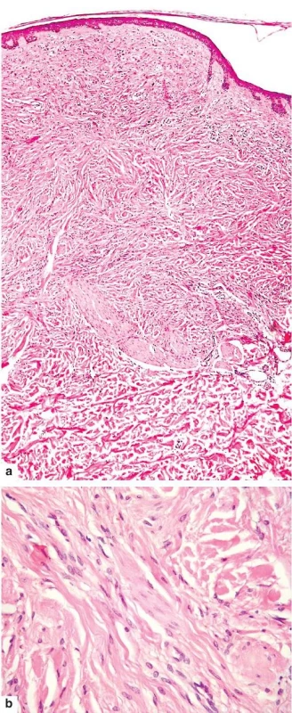 Desmoplastické névus
a – vyklenutá, minimálně pigmentovaná léze ve zhrubělém kolagenním vazivu
b – je tvořena vřetenitými nepigmentovanými melanocyty