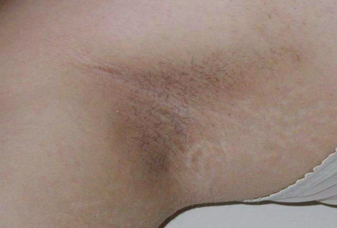 Acanthosis nigricans v axile u 14leté dívky s diabetes mellitus 2. typu. Ložiska acanthosis nigricans – tmavé kůže s hyperkeratózou a hrubým reliéfem – jsou typická pro mladistvé s diabetem 2. typu. Nacházíme je nejčastěji na zátylku, v axilách a u pacientů s morbidní obezitou na vnitřních stranách stehen.