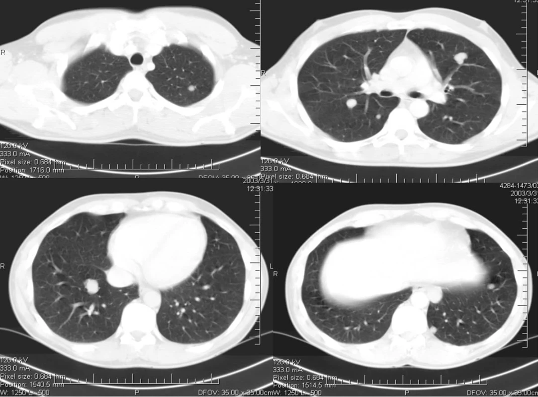 CT plic s mnohočetnými metastázami
Pic. 1. CT scan with multiple lung metastases