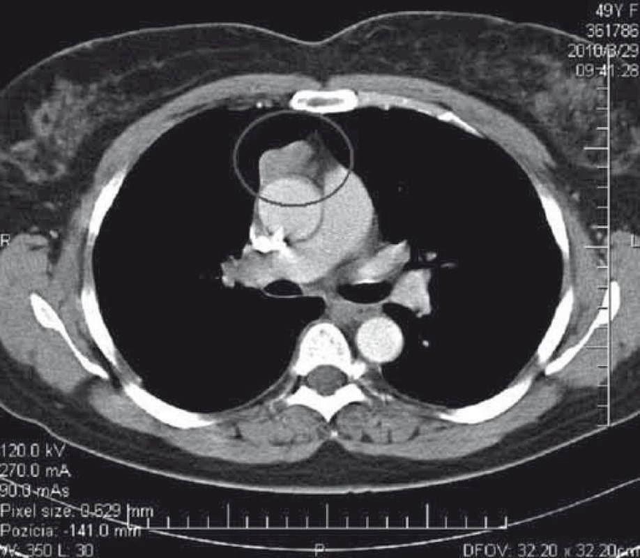 CT hrudníka s kontrastnou látkou – opúzdrený tymóm, štádium I podľa Masaoka.
Tymóm bol chirurgicky kompletne excidovaný.
Fig. 1. CT of the chest with a contrast medium – encapsulated thymoma, Masaoka stage I.
Thymoma was completely surgically resected.