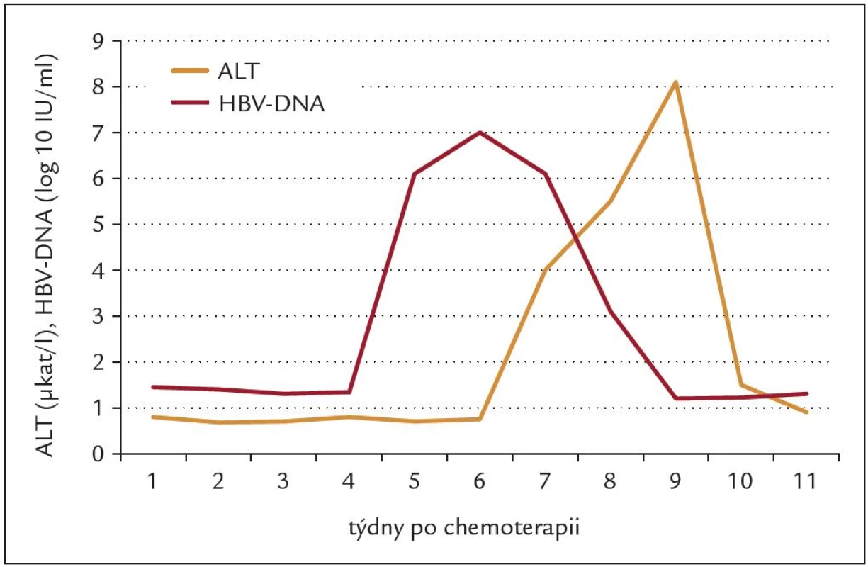 Průběh reaktivace chronické hepatitidy B po 1 cyklu chemoterapie. Vzestup viremie předchází vzestupu aktivity ALT.