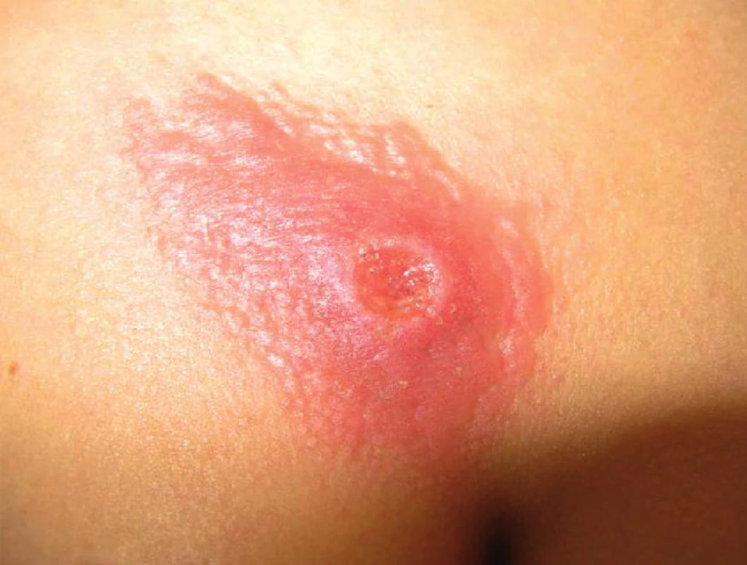 Syphilis primaria, ulcus durum reg. sternalis.