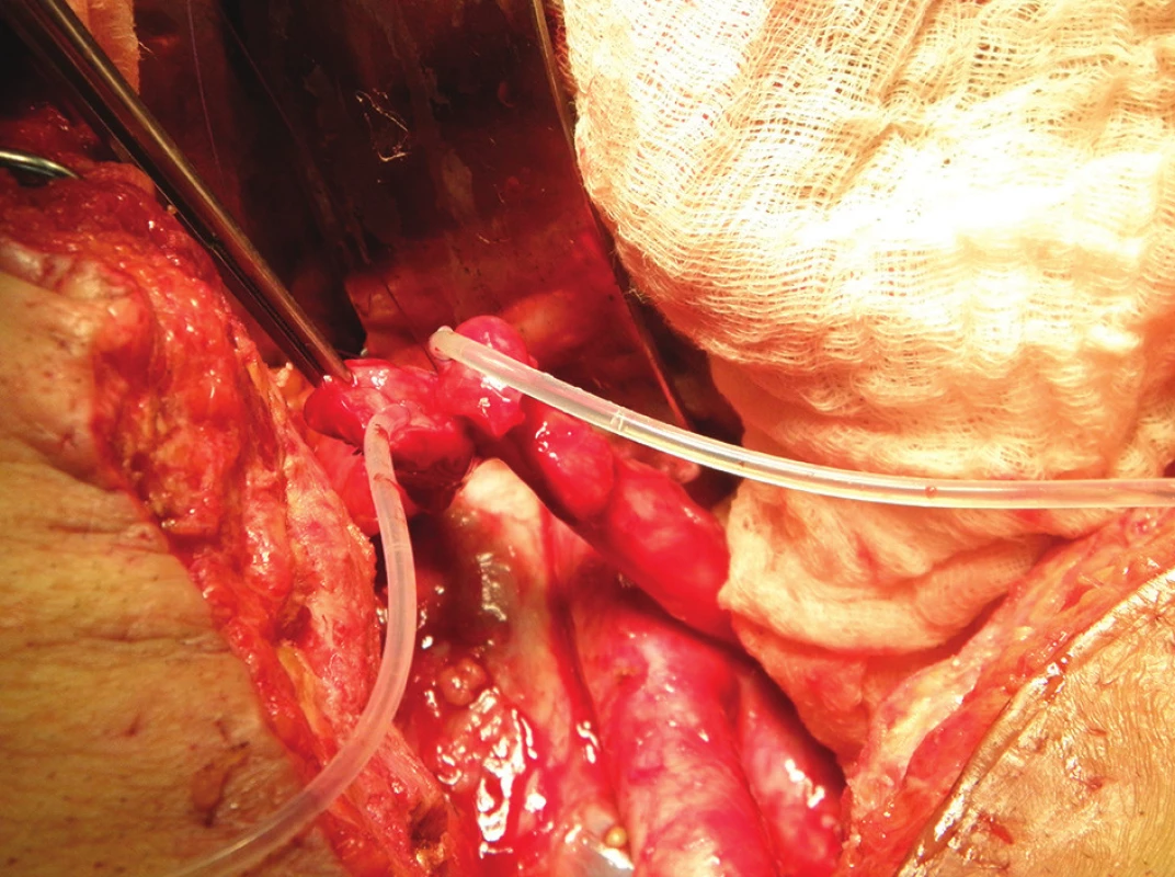 Operační nález: příprava společné lišty obou ureterů před ureteroileoanastomózou – do obou ureterů jsou zavedeny splinty
Fig. 5: Surgical finding: preparation of the common urethral plate before constructing ureteroileoanastomosis – splints were inserted into both ureters