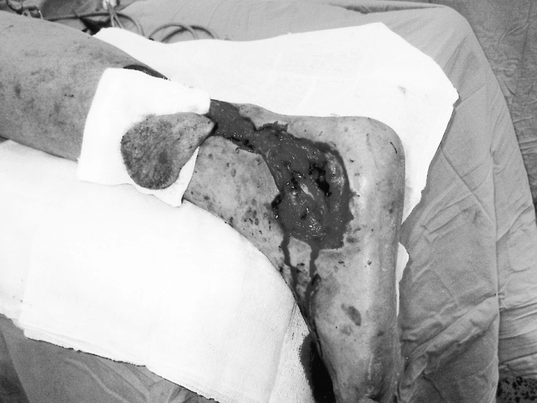 Peroperační snímek po debridement spodiny defektu a vytvořeném laloku
Pic. 2. Peroperative view after debridement of the defect base and flap construction