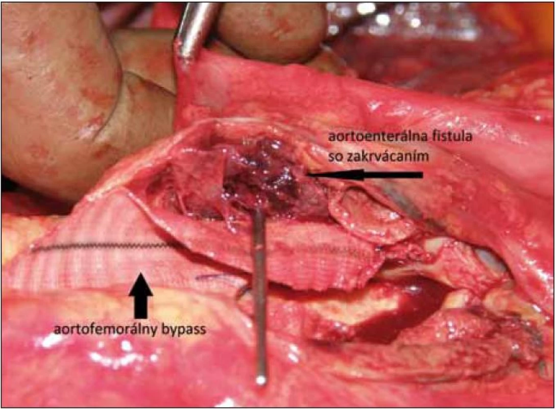 Pohľad na aortoenterálnu fistulu zo strany aortofemorálneho bypassu (autor fotografie: MUDr. Svetoslav Štvrtina, PhD., Ústav patologickej anatómie Lekárskej fakulty UK v Bratislave).