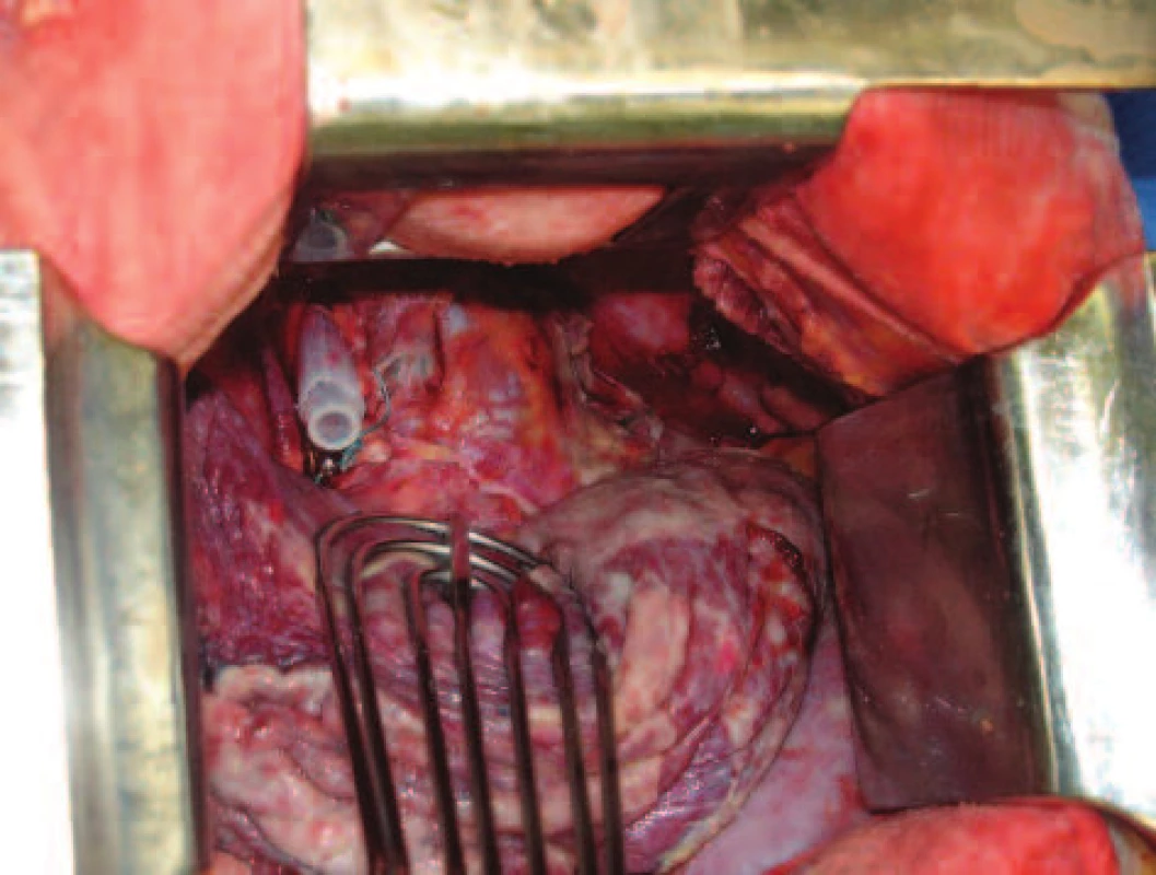Proplachový drén protažený cervikálním přístupem pretracheálně pleurálně vpravo
Fig. 4: A lavage drainage is installed through the cervical approach to the pretracheal right  pleural space