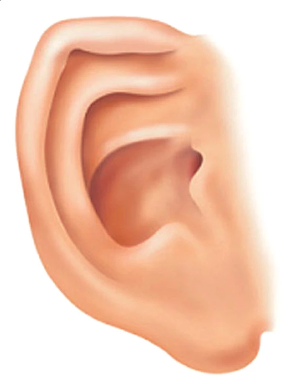 Anomálie boltce u FAS. Hypoplastická horní část boltce a záhyby tvaru železničních kolejí. (Převzato z Wattendorf DJ, Muenke M, 2005) 
Fig. 3. Anomalies of ear auricle in FAS. Hypoplastic upper pat of auricle and folds in the shape of railway rails. (Adopted fromWattendorf DJ, Muenke M, 2005)