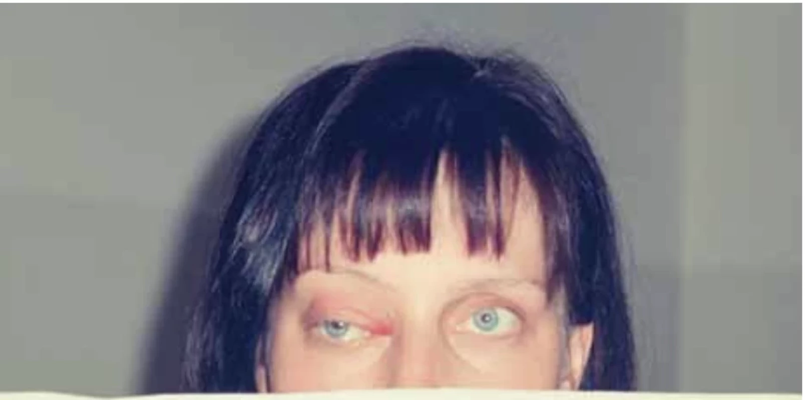 Protrusion of the right eye. // Protruze pravého oka.